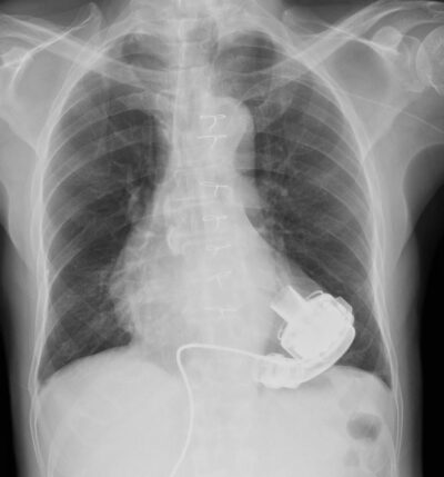 LVAD (Left Ventricular Assist Device) - MR IMPLANT