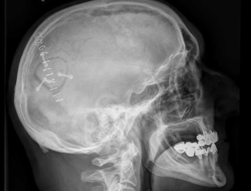 Craniotomy Plate MR IMPLANT