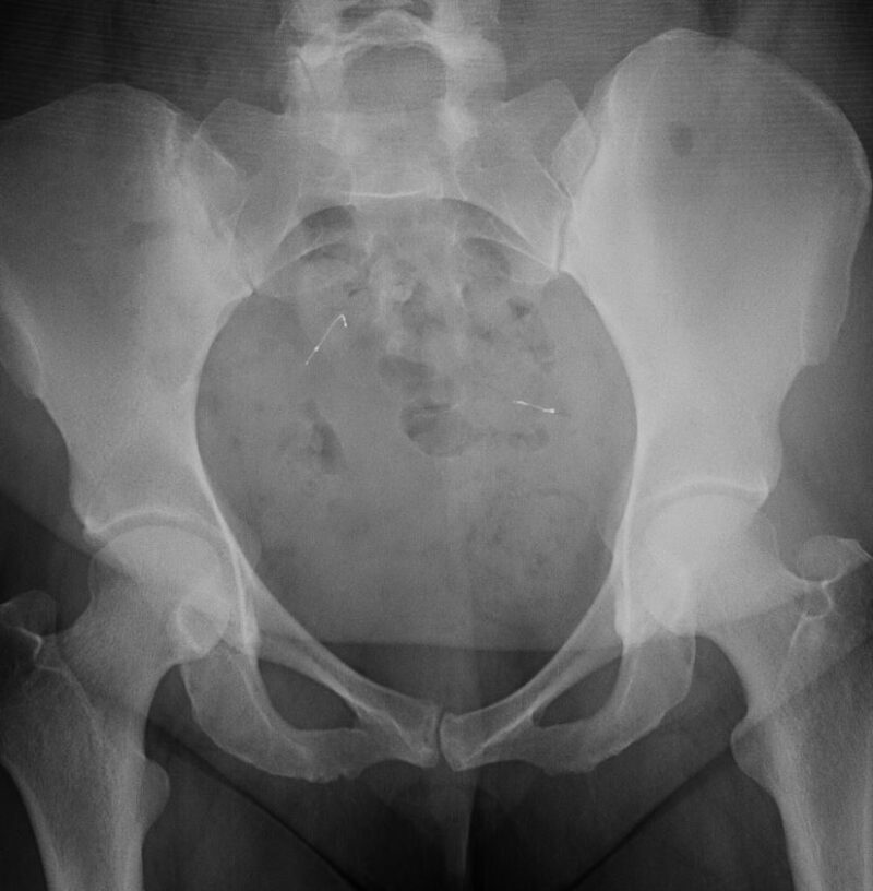 Fallopian Tube Coils MR IMPLANT