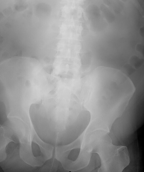 Foley Catheter Temperature Probe MR IMPLANT