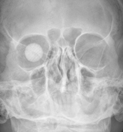 Orbital and Ocular Prostheses - MR IMPLANT
