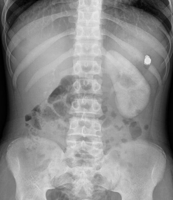 Pill Capsule Endoscopy MR IMPLANT
