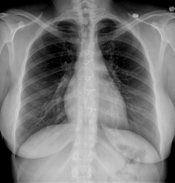 Sternal Wires MR IMPLANT