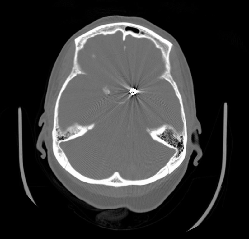Aneurysm Coils (Intracranial) MR IMPLANT