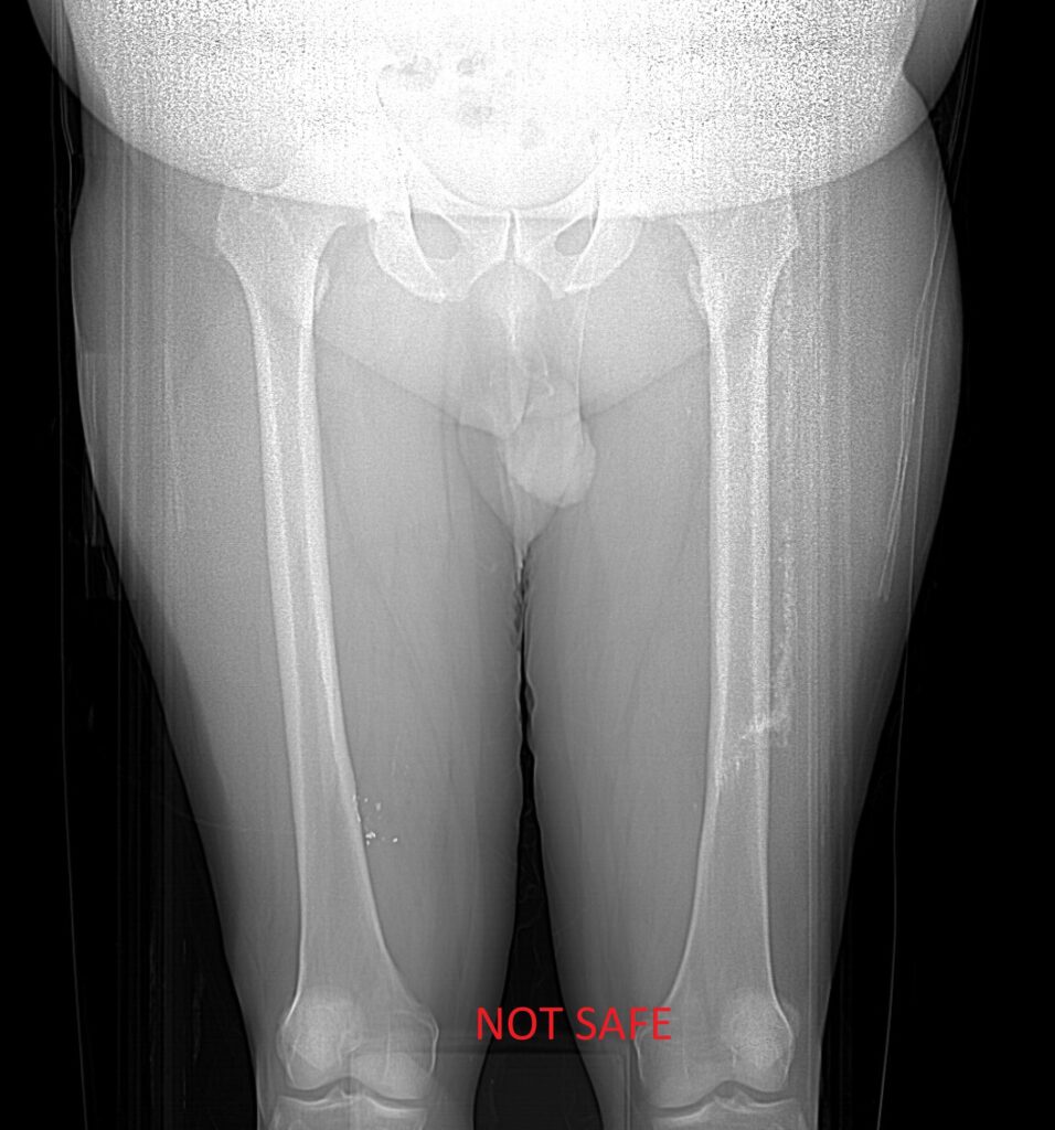 Bullets and Shrapnel - MR IMPLANT