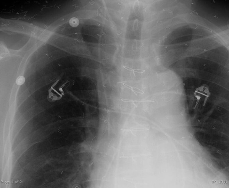 Acupuncture Needle MR IMPLANT