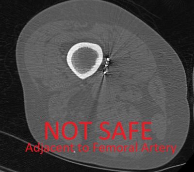 Shrapnel Injuries Bone Bullets and Shrapnel - MR IMPLANT